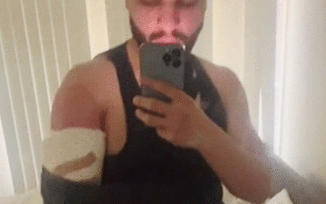 selfie of a man with torn bicep