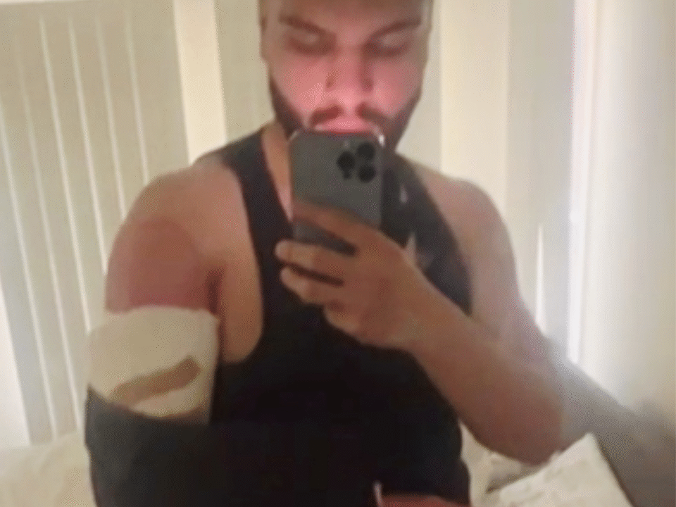 selfie of a man with torn bicep